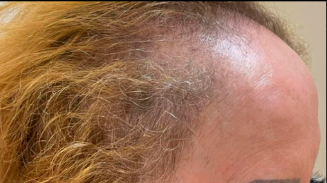 c.prof 230 hair loss solution - antes 1