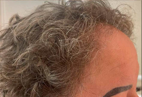 c.prof 230 hair loss solution - depois 1