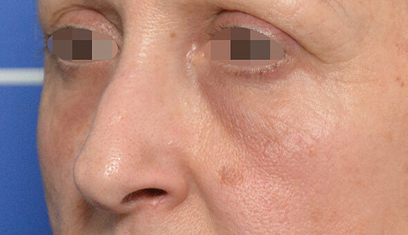 mesofiller® periocular - depois 1