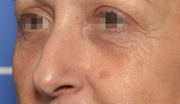 mesofiller® periocular - antes 1