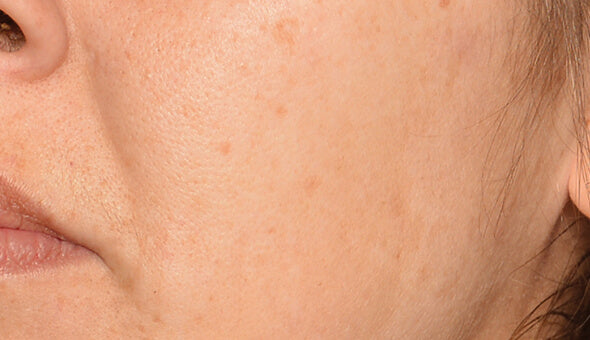 c.prof 218 depigmentation solution - depois 1