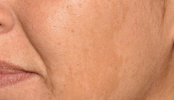 c.prof 218 depigmentation solution - antes 1